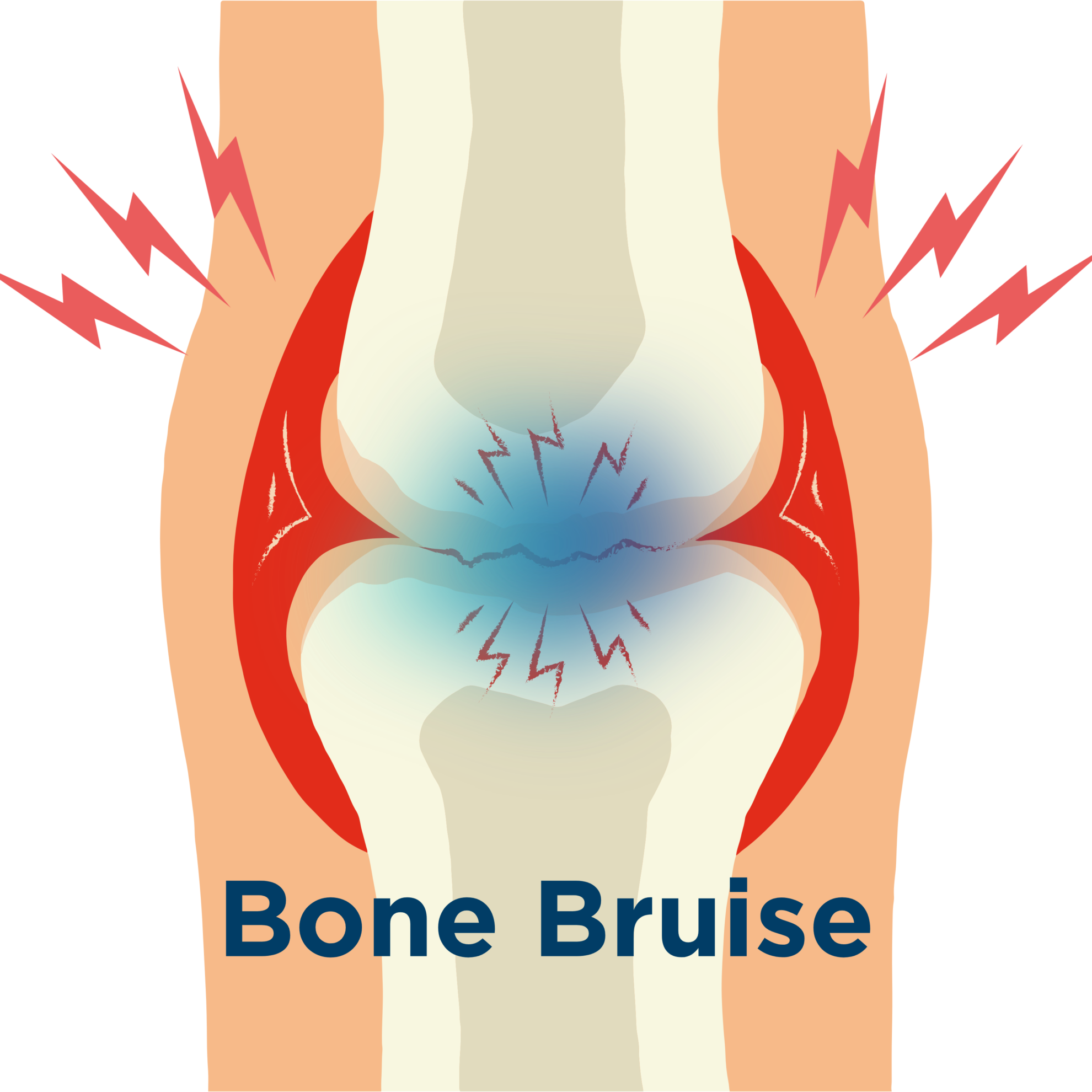Bone Bruise Behandlungsdauer